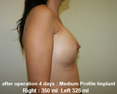 plastic-surgery-breast-augmentation